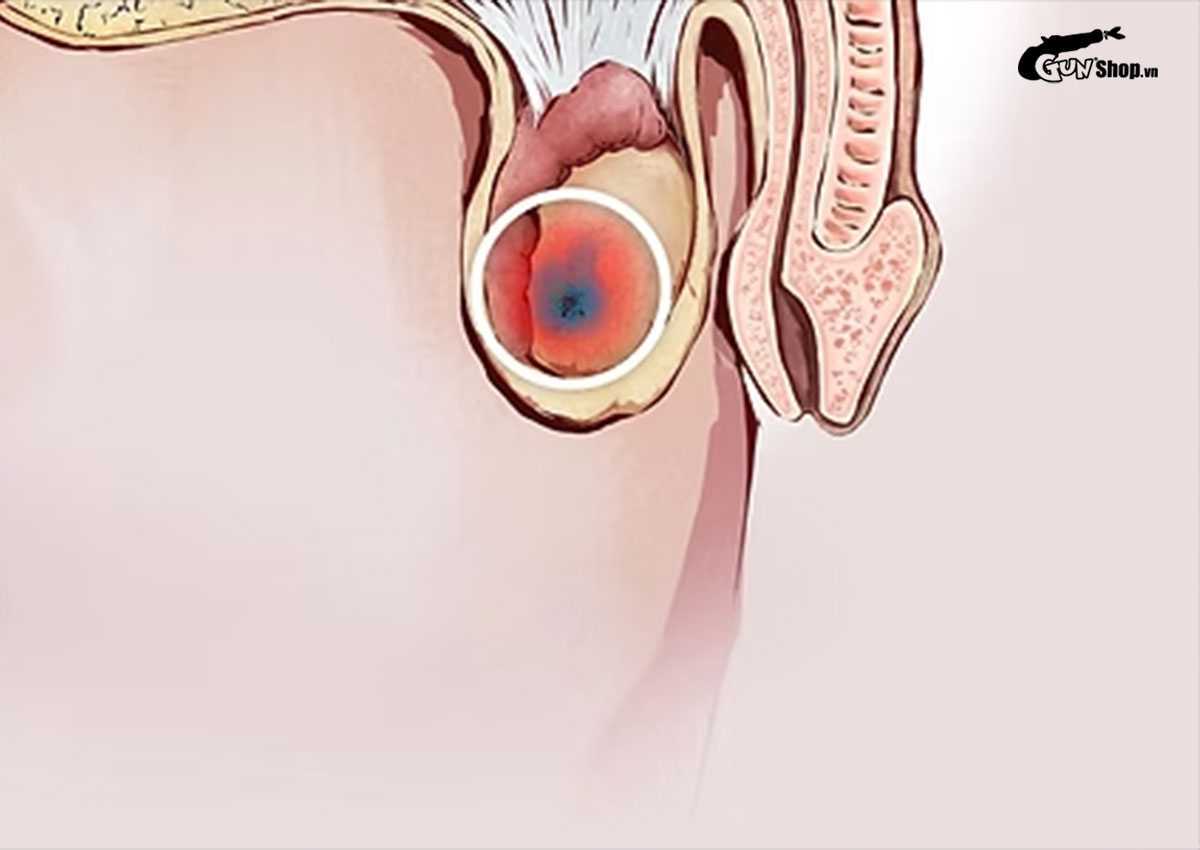 Tinh trùng yếu: Cách nhận biết, nguyên nhân và phòng ngừa