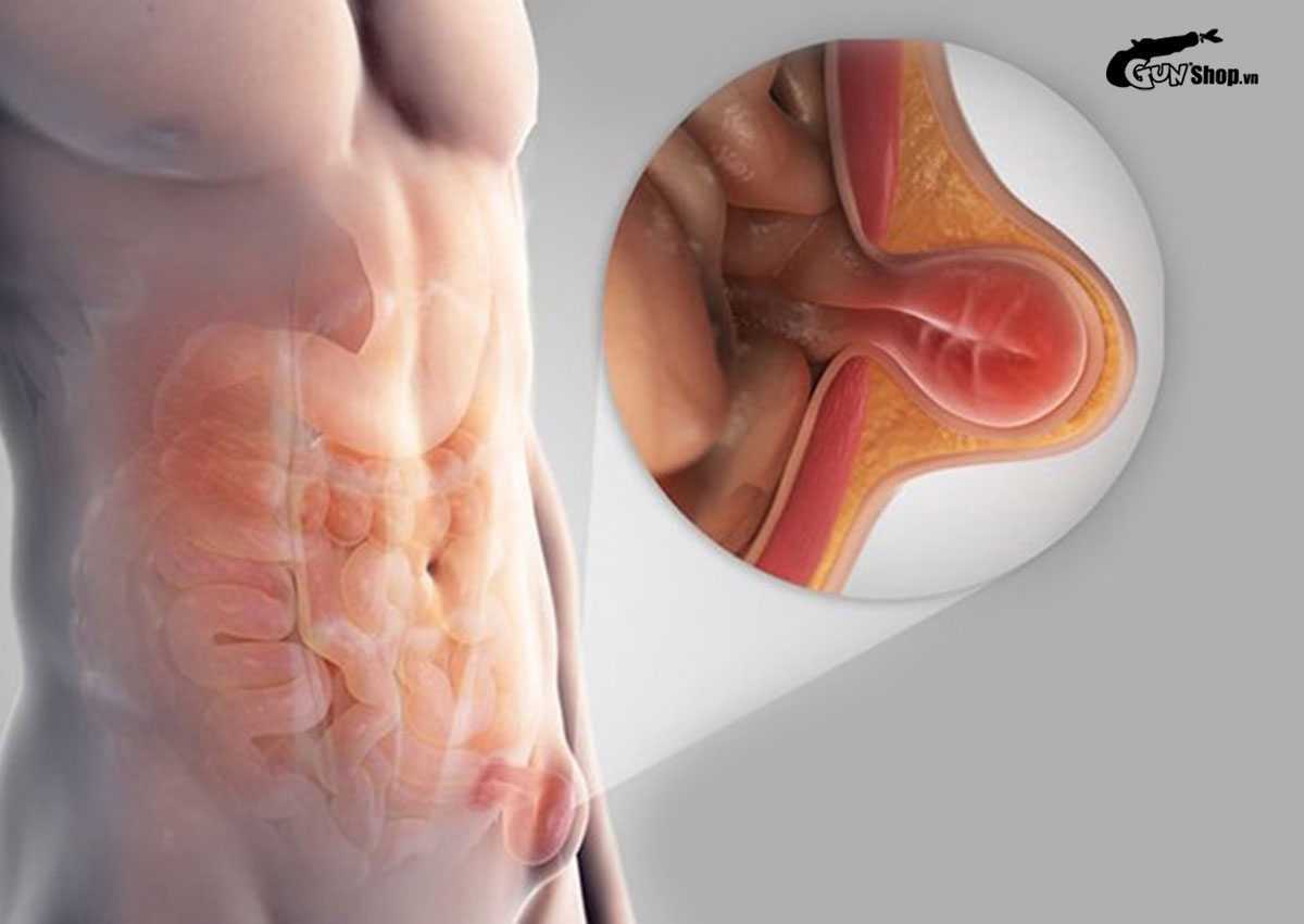 Tràn dịch màng tinh hoàn là gì? Có nguy hiểm không? Cách điều trị