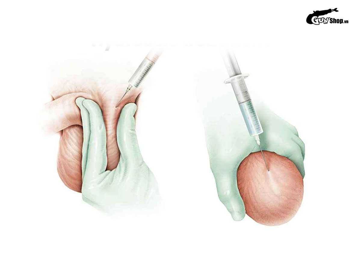 Tràn dịch màng tinh hoàn là gì? Có nguy hiểm không? Cách điều trị