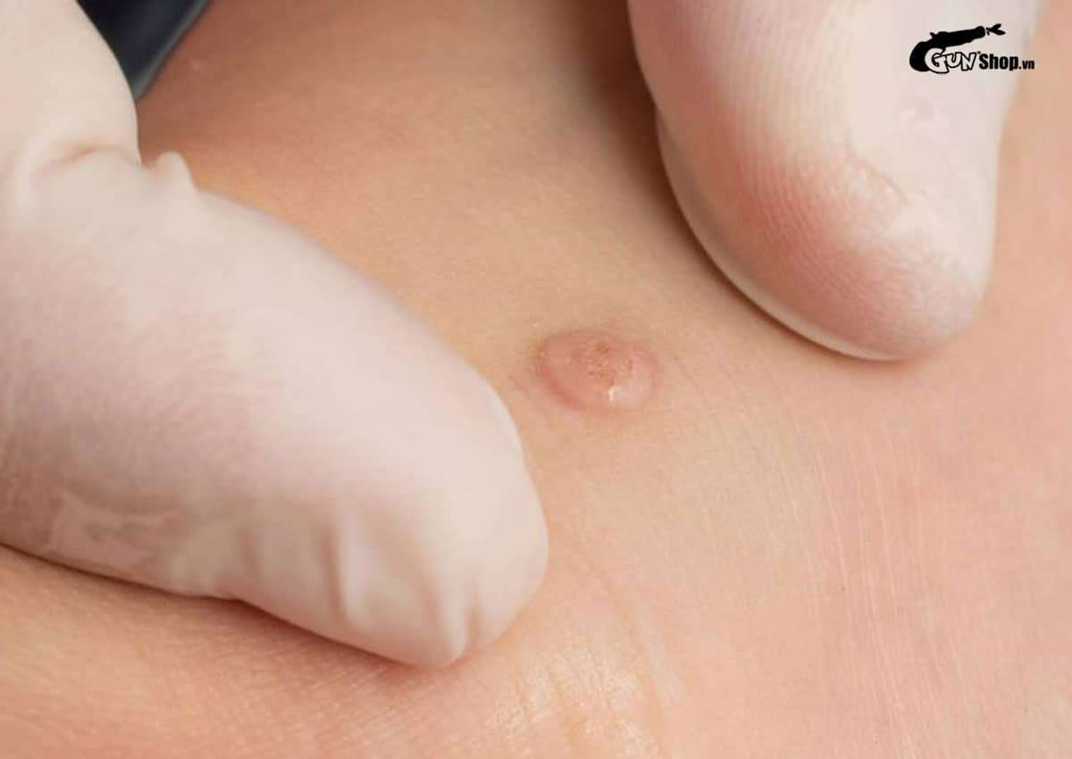 Quan hệ với người nhiễm HPV bao lâu thì bị? Thời gian và biểu hiện nhiễm