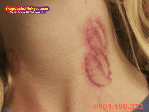 Cơ chế sinh học gây vỡ mao mạch tạo nên dấu hickey trên da