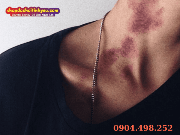 Giải đáp thắc mắc về cảm giác và thời gian tan hickey