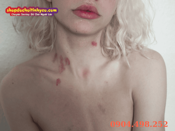 Các mẹo dân gian hiệu quả để xóa dấu hickey thần tốc tại nhà