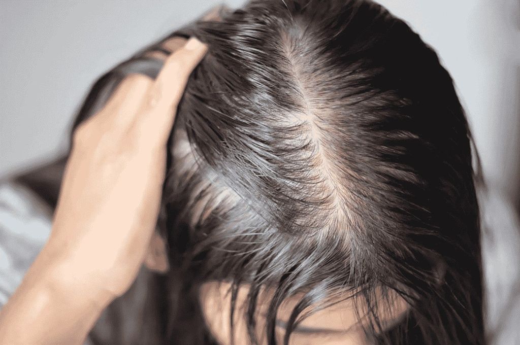 Tóc rụng khắp đầu khiến tóc mỏng đi trông thấy