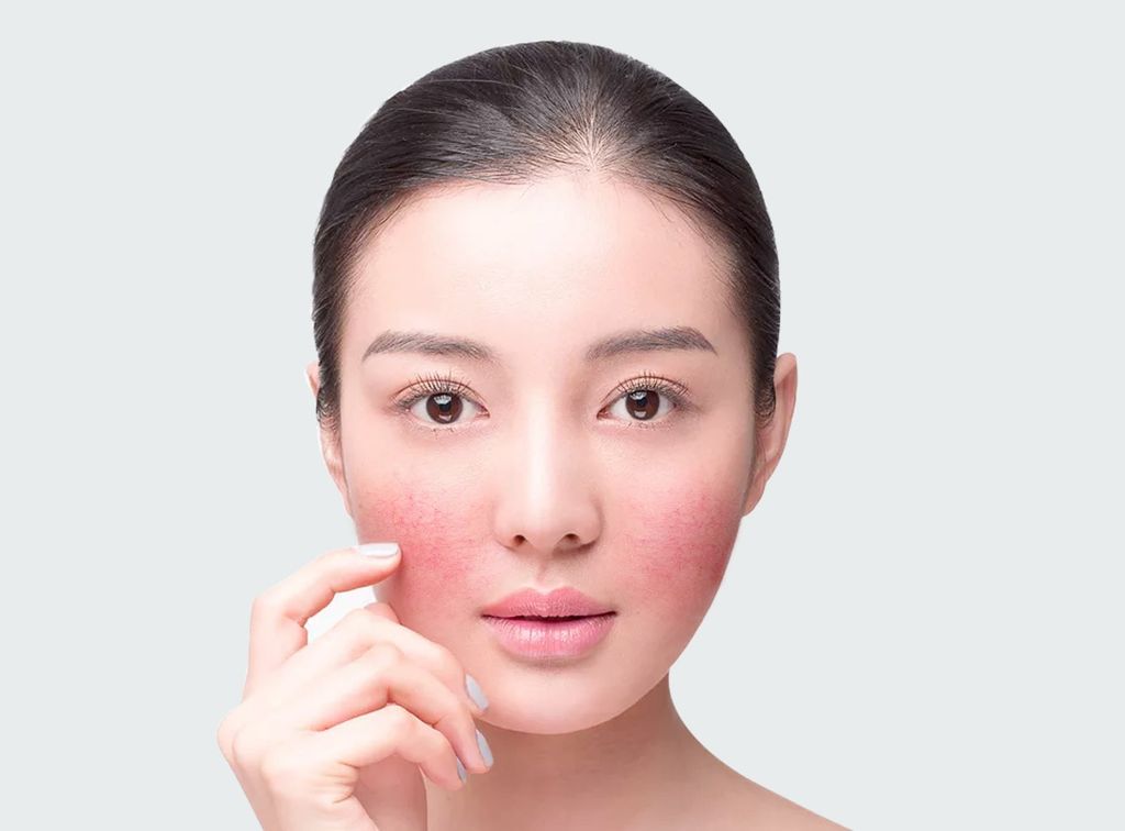 Da nhạy cảm có thẻ bị đỏ rát và kích ứng rất mạnh