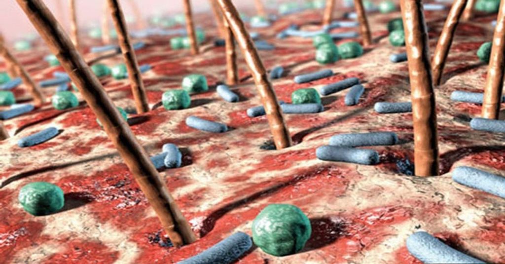 Vi khuẩn P.Acnes phát triển mạnh khiến da mụn khó kiểm soát