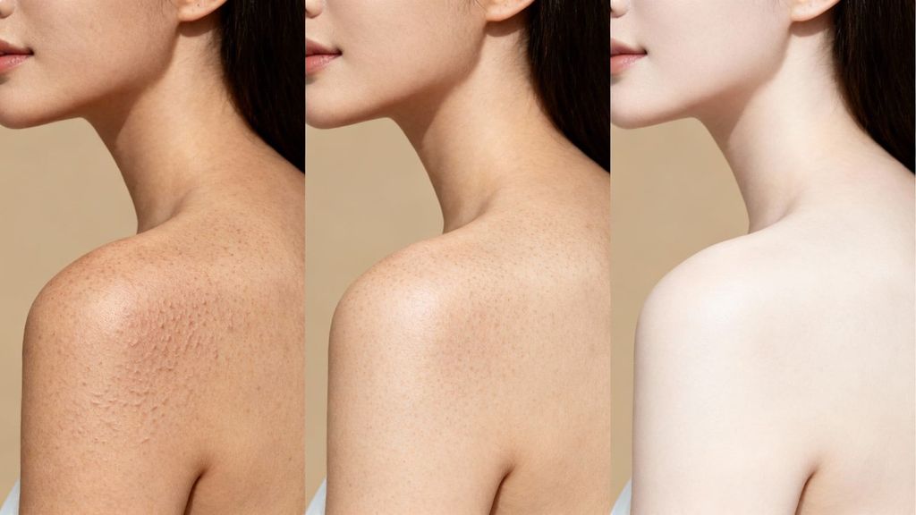 Muốn cải thiện làn da mụn cần thời gian để phục hồi dần