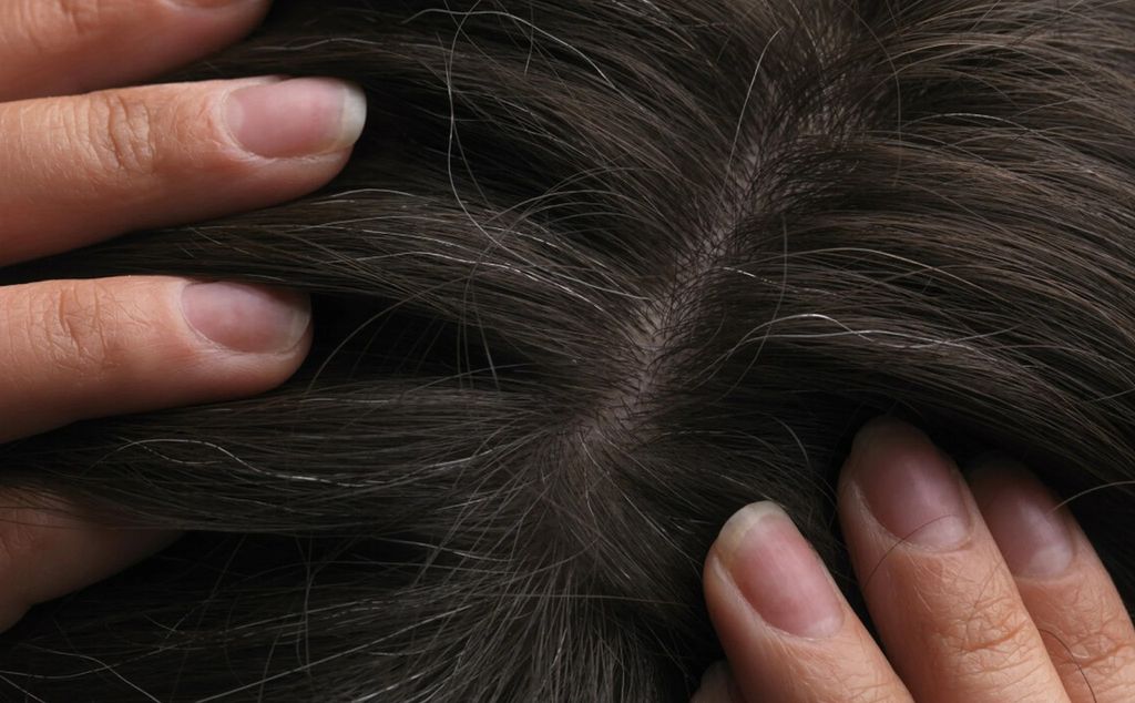 Tóc bạc sớm do nguyên nhân di truyền rất phổ biến