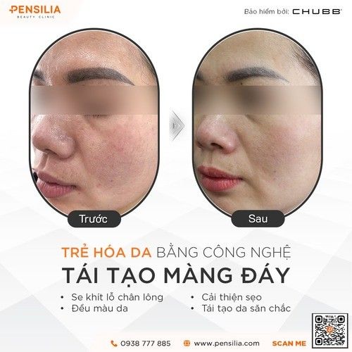 tre-hoa-da-tang-truoc-sau