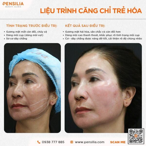 chi-collagen-truoc-sau