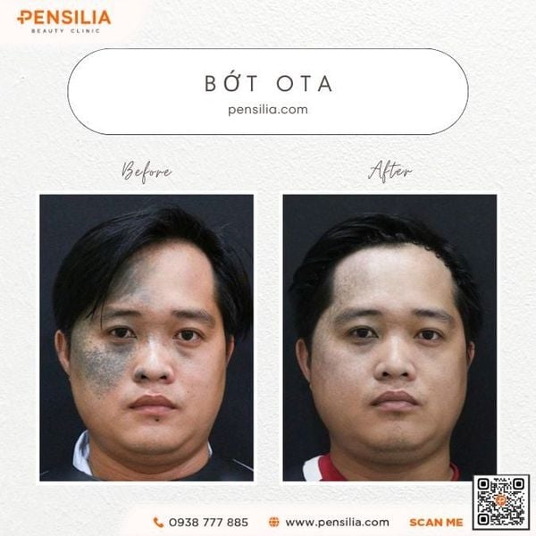 bot-ota-bam-sinh-truoc-sau