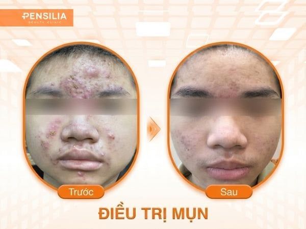 cach-tri-mun-truoc-sau-pensilia