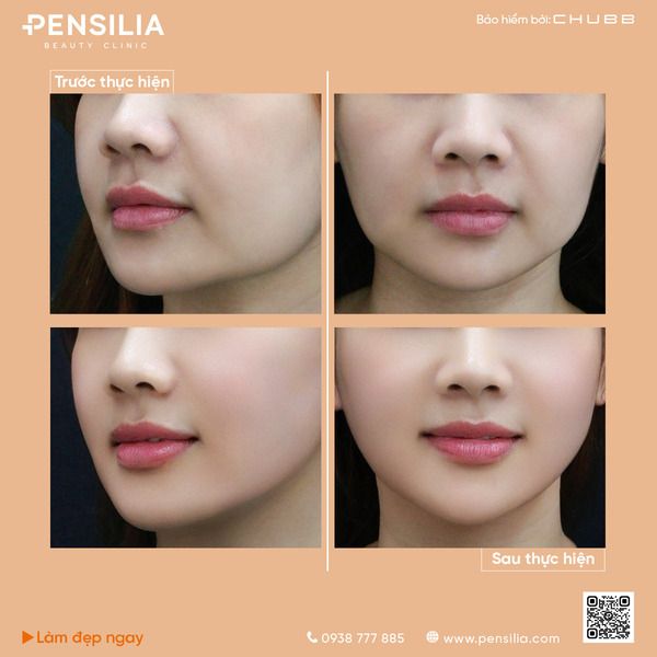 cang-chi-tre-hoa-truoc-sau