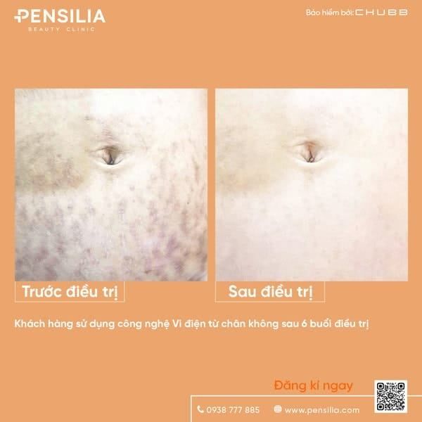 dau-ran-da-truoc-sau