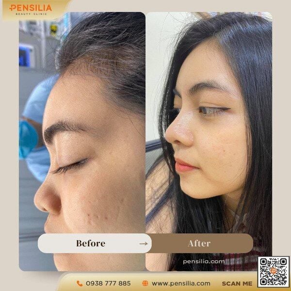 nang-mui-chi-collagen-truoc-sau-pensilia