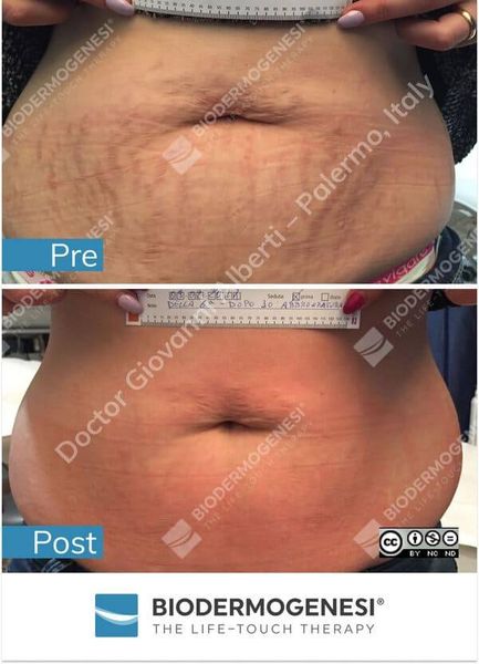 ran-bung-sau-sinh-truoc-sau