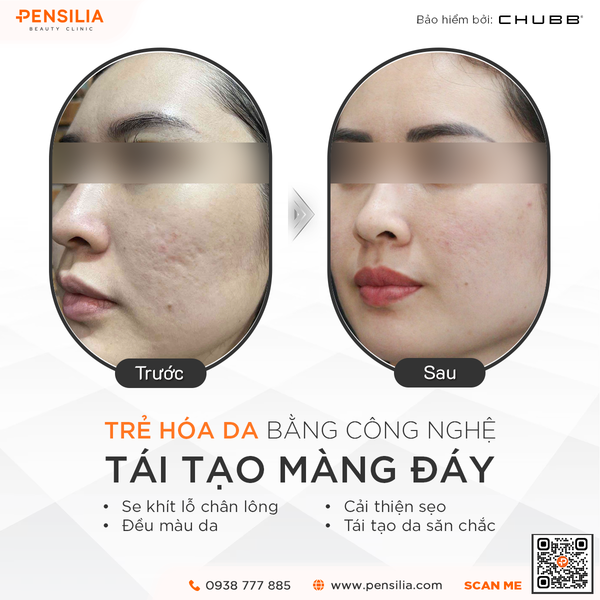 meso-exosome-truoc-sau