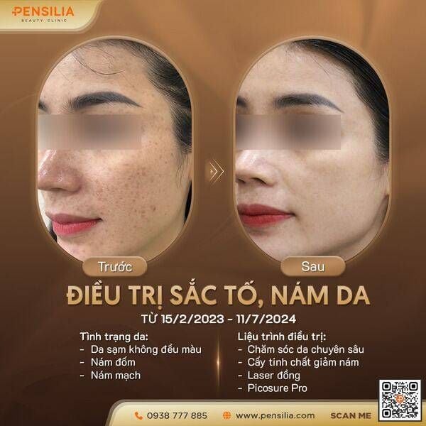 peel-da-co-het-nam-khong-truoc-sau