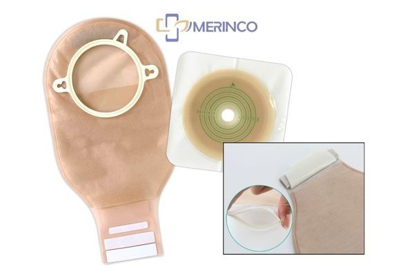 Túi hậu môn nhân tạo loại kẹp rời hay loại dán tốt hơn?