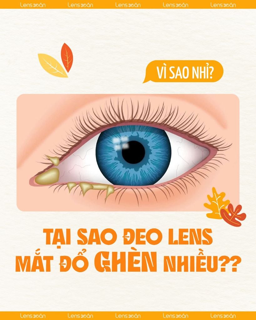 Vì sao đeo lens mắt đổ ghèn nhiều – Nguyên nhân phổ biến & cách xử lý an toàn