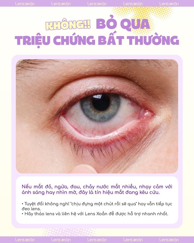 Cảnh báo triệu chứng mắt bất thường – Chăm sóc từ Lens Xoắn