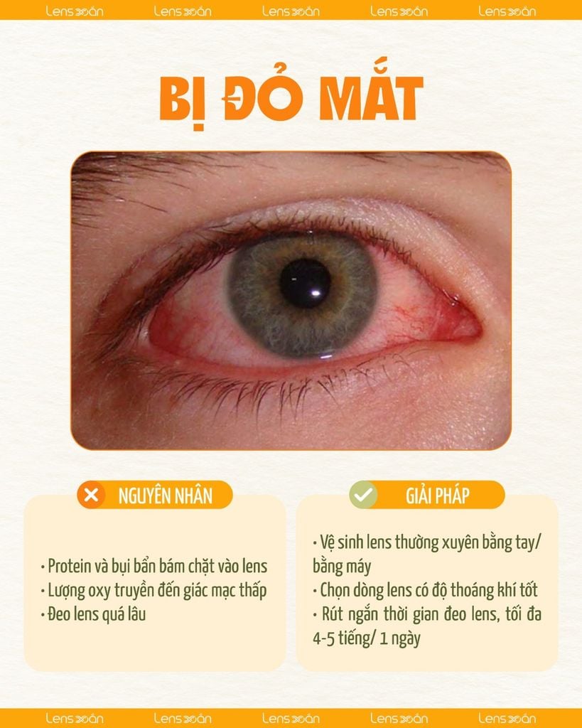 Những vấn đề thường gặp khi newbie mới đeo lens và cách xử lý an toàn