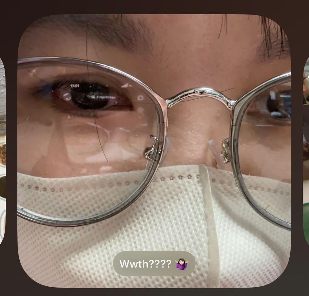 Mắt đỏ rát khi bị viêm kết mạc – nguyên nhân có phải do lens?