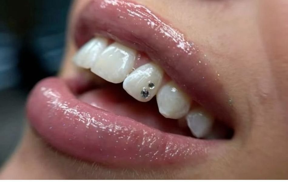 Gắn hột xoàn hay đính kim cương lên răng là phương pháp nha khoa thẩm mỹ sử dụng các viên đá quý, kim cương có kích thước nhỏ để cố định lên bề mặt răng