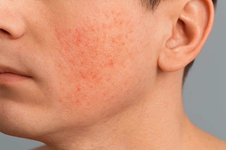 Vi chấn thương da và cảm giác rát