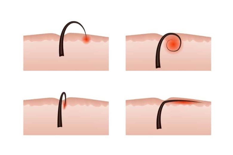 Razor burn và lông mọc ngược