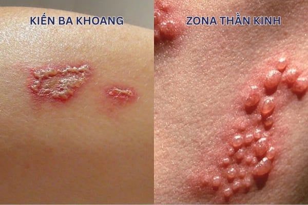Phân biệt vết đốt kiến ba khoang với zona thần kinh
