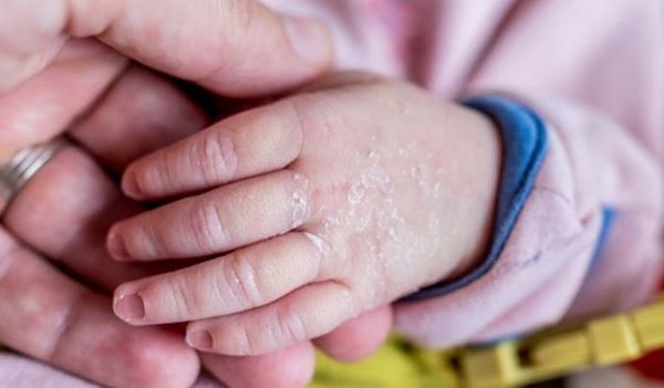 dấu hiệu nhận biết bé thiếu vitamin C