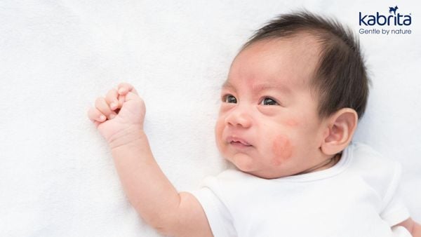 dấu hiệu trẻ dị ứng sữa