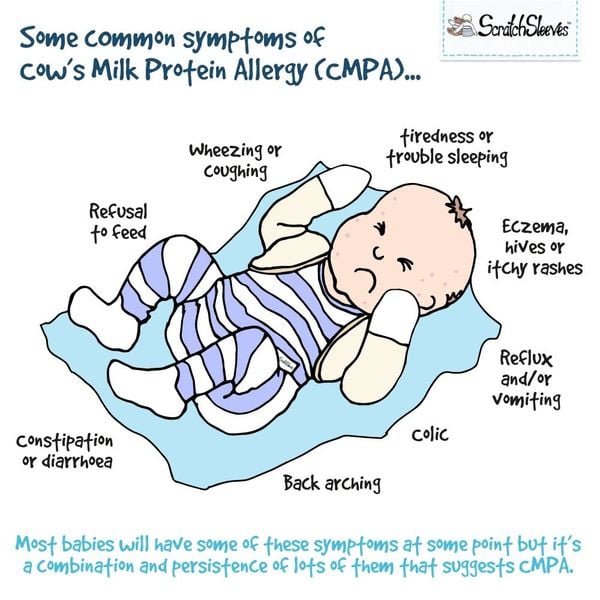 dấu hiệu trẻ dị ứng đạm bò