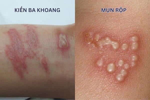 Phân biệt vết đốt kiến ba khoang với mụn rộp