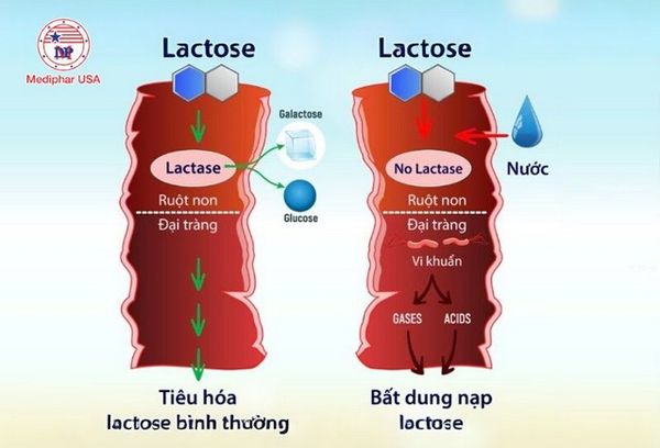 Nguyên nhân bất dung nạp lactose