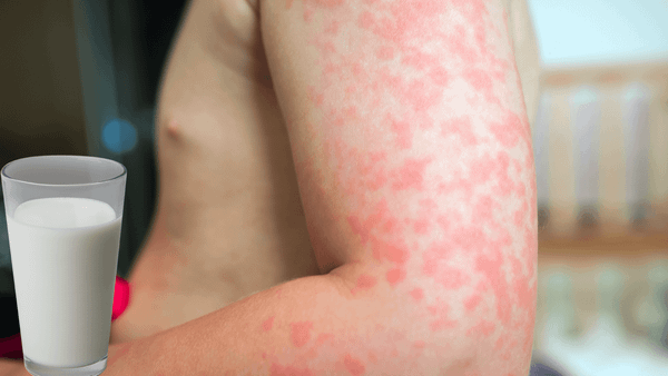 Nguoi bat dung nap lactoso va nguoi di ung sua