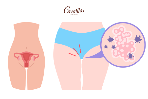 Ngứa vùng kín là bệnh gì? Cách giảm ngứa nhanh và hiệu quả