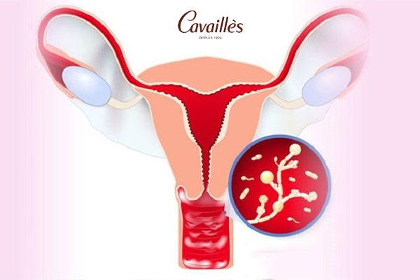 Bệnh lậu ở nữ giới là gì?