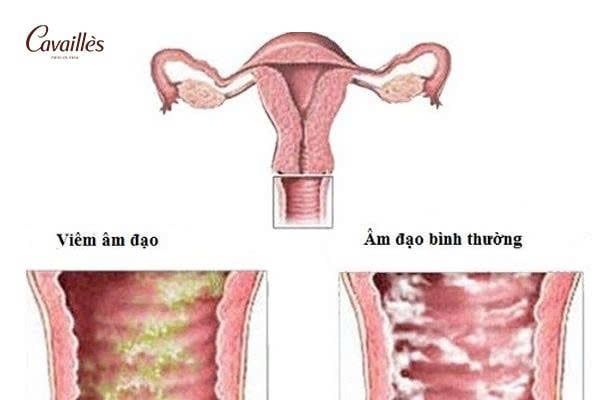 Viêm âm đạo là gì?