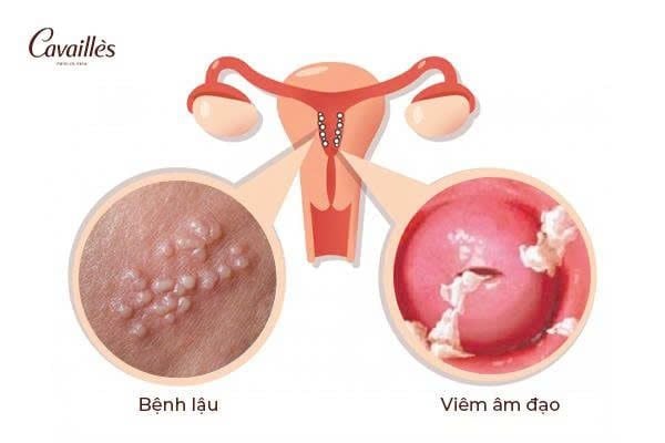 So sánh bệnh lậu và viêm âm đạo