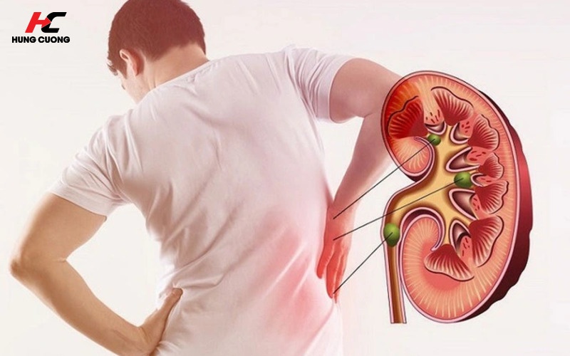 Suy giảm chức năng thận đối với bệnh nhân tiểu đường