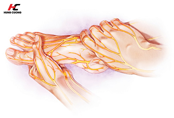Đường huyết cao làm tổn thương hệ thần kinh