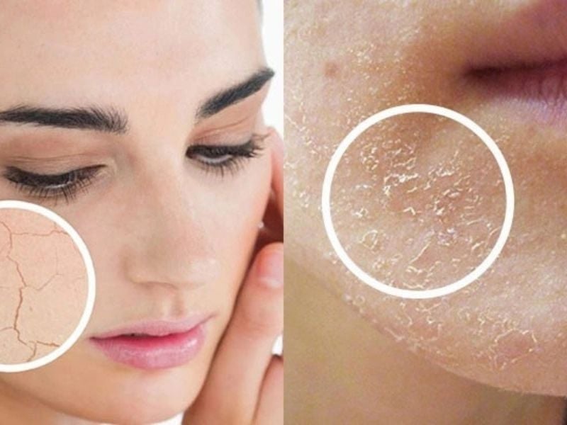 nguyen-nhan-dan-den-da-kho