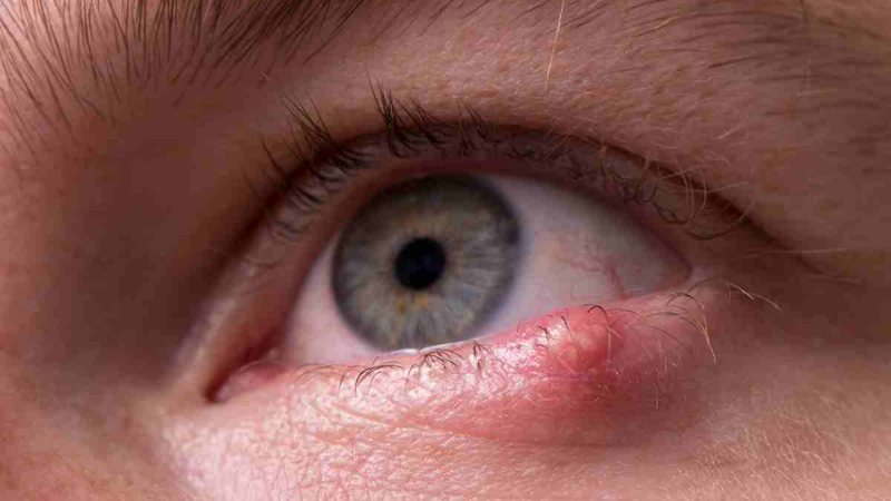 U da mi là khối bất thường xuất hiện tại bờ mi