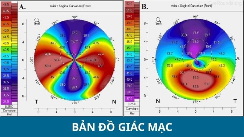 Hình ảnh bản đồ giác mạc thể hiện độ cong và độ đều bề mặt giác mạc qua hệ thống đo chuyên dụng.