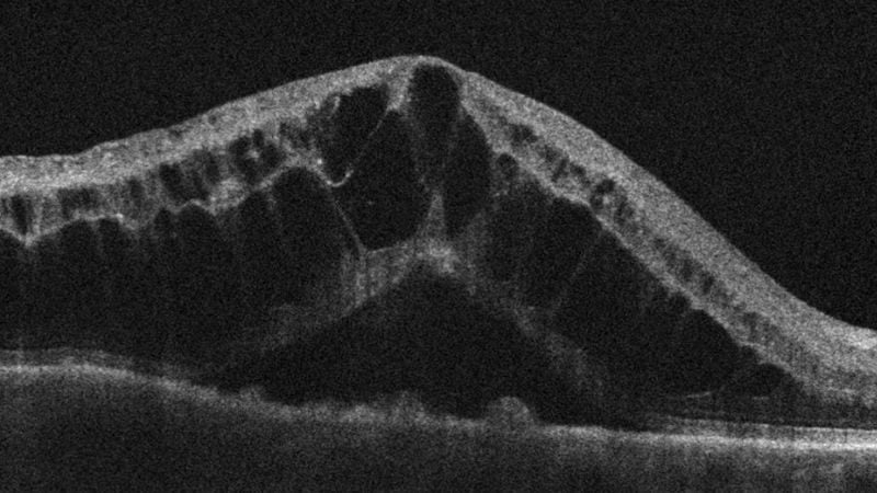 Hình ảnh OCT cho thấy phù hoàng điểm dạng nang.