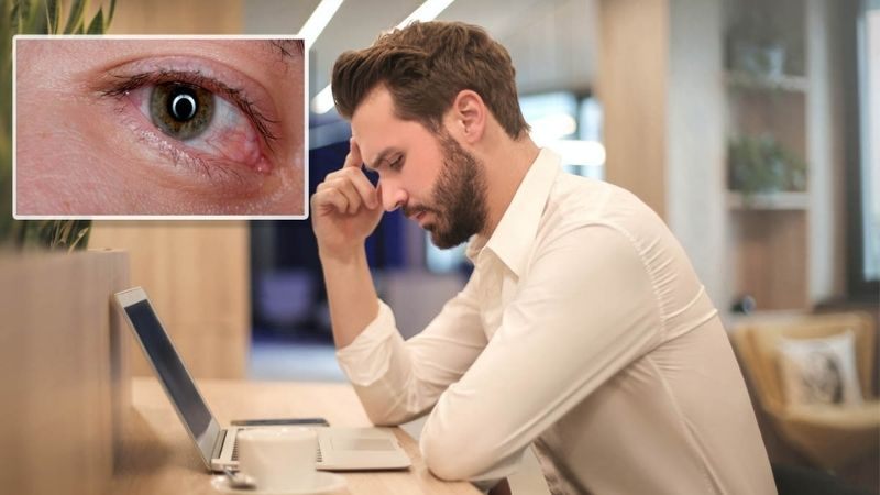 Những triệu chứng chủ quan cảnh báo bạn đang mắc dấu hiệu khô mắt và cần thăm khám sớm