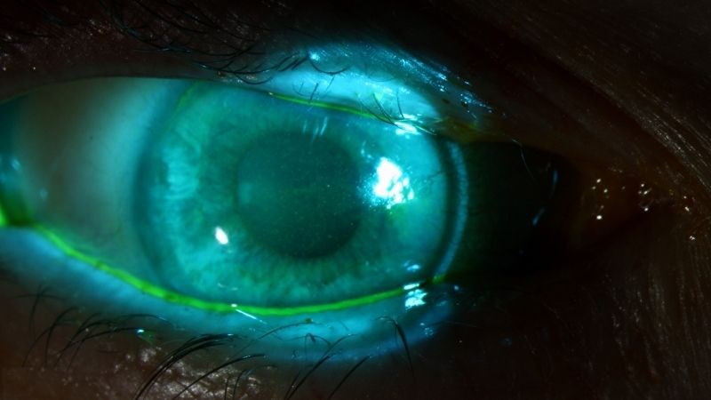 Bài kiểm tra đo thời gian phim nước mắt bị phá vỡ bằng cách nhỏ một lượng thuốc nhuộm huỳnh quang lên mắt