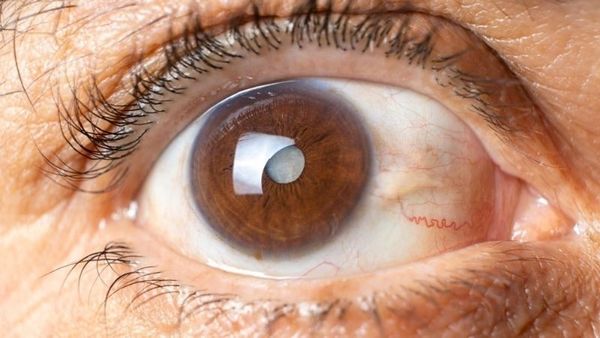 Dấu hiệu tổn thương thần kinh thị giác trong glaucoma với lõm gai sâu bất thường.